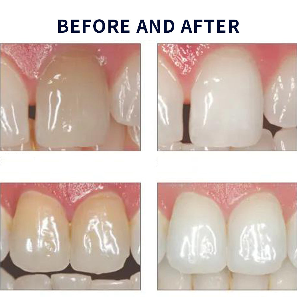 مجموعة جل تبييض أوباليزانس ، م - مراجعة Teeth Whitening At Home Kit وسعره