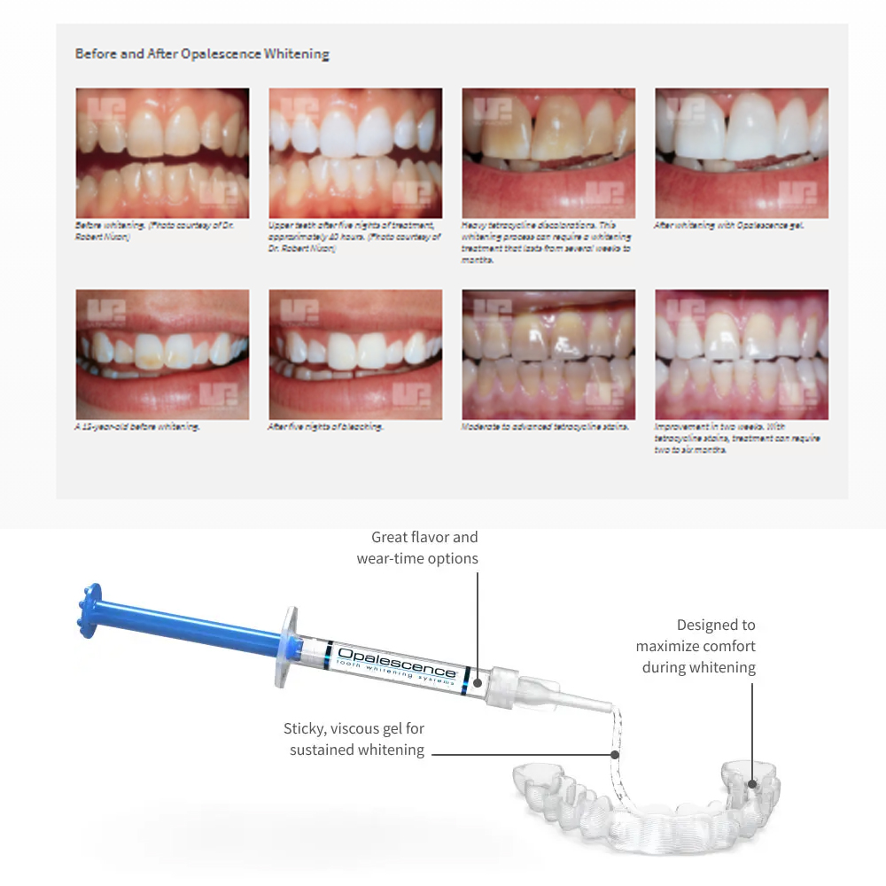 مجموعة جل تبييض أوباليزانس ، م - مراجعة Teeth Whitening At Home Kit وسعره